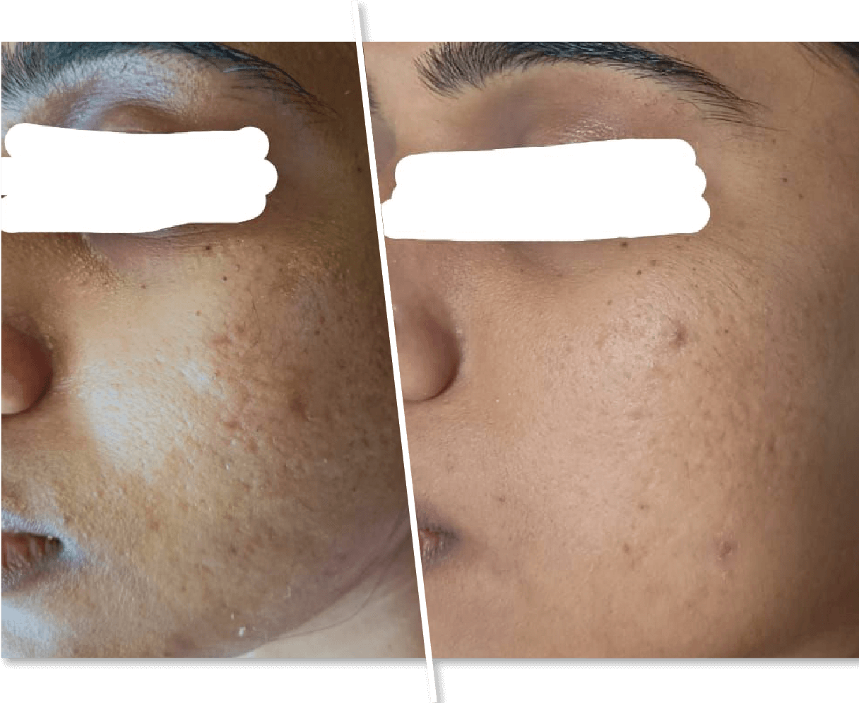 Acne Treatment Before and After Photos